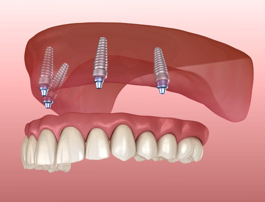 implant-supported-denture-1024x779.jpg.optimal