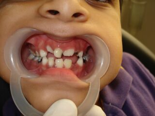 Cavity development on teeth