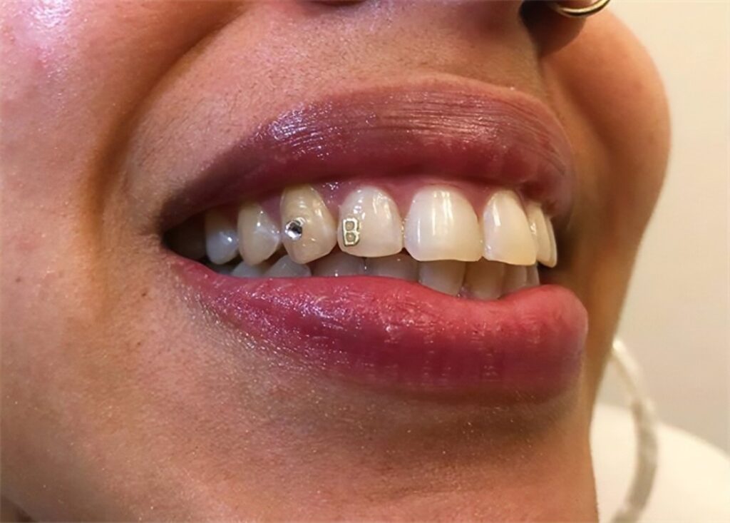 Dental gems