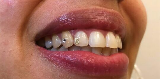 Dental gems