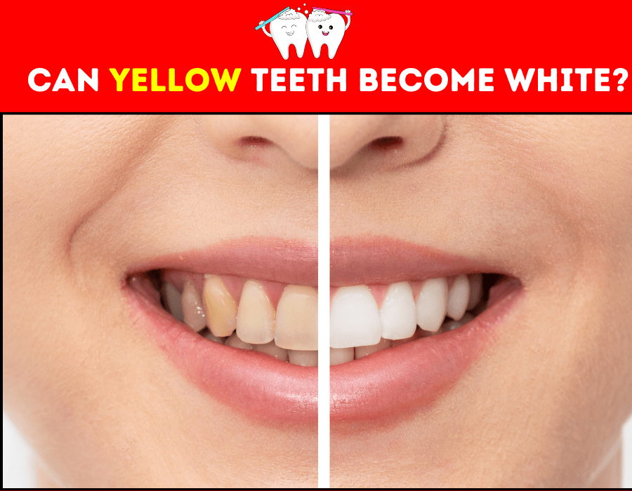 Can Yellow Teeth Become White?