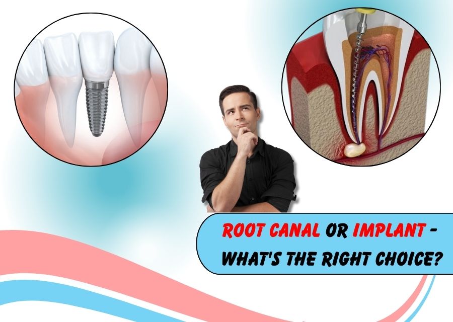 Root Canal Or Implant - What’s The Right Choice