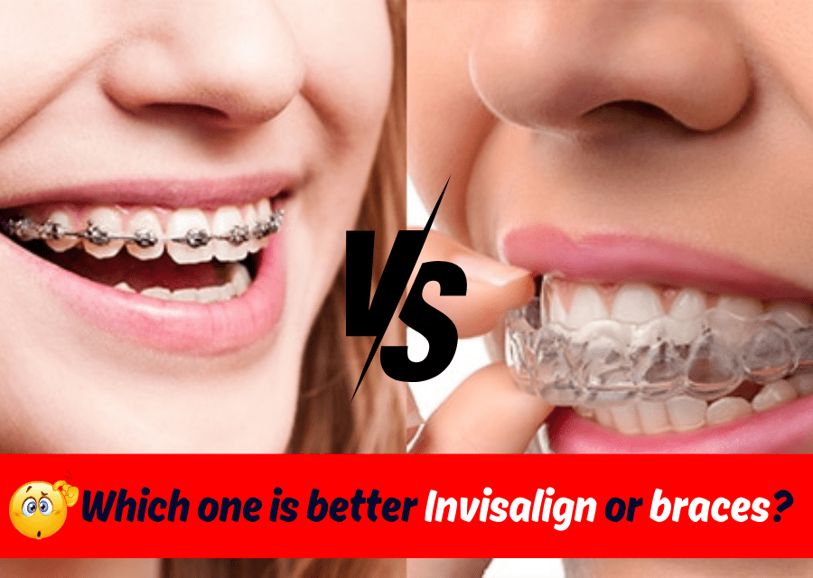 Which One Is Better Invisalign Or Braces?