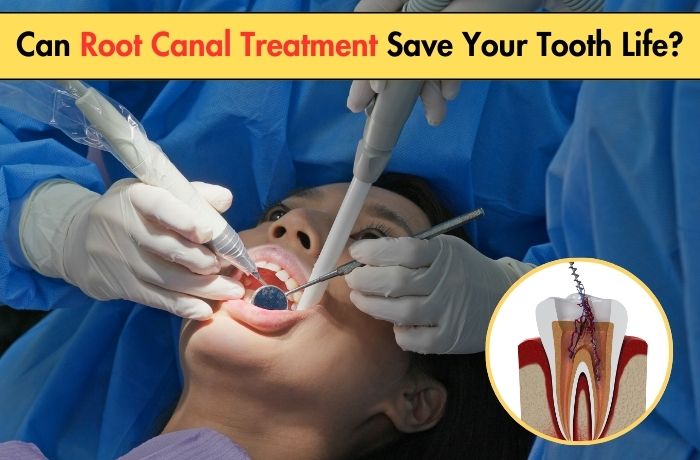 Can Root Canal Treatment Save Your Tooth Life?