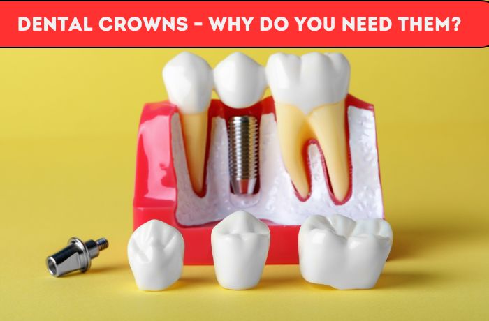 Dental Crowns: Why Do You Need Them?