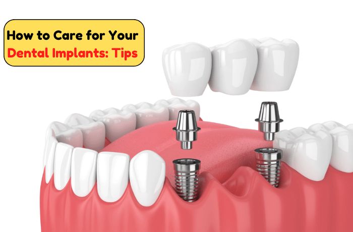 How to Care for Your Dental Implants Tips