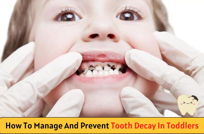 How to Manage and Prevent Tooth Decay in Toddlers