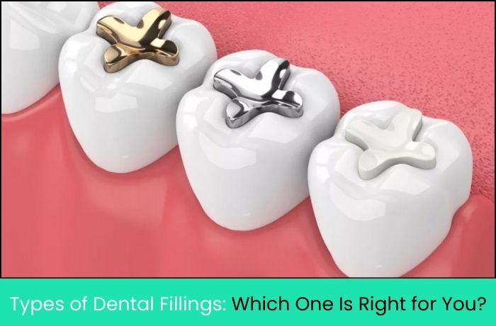 Types of Dental Fillings: Which One Is Right for You?