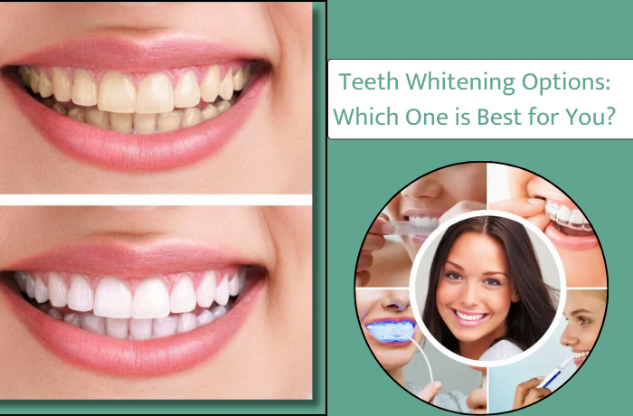 Teeth Whitening Options: Which One is Best for You?