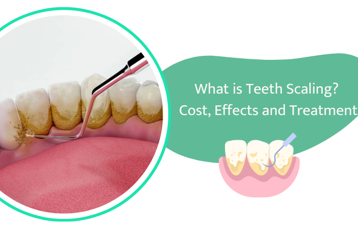 What is Teeth Scaling? Cost, Effects and Treatment