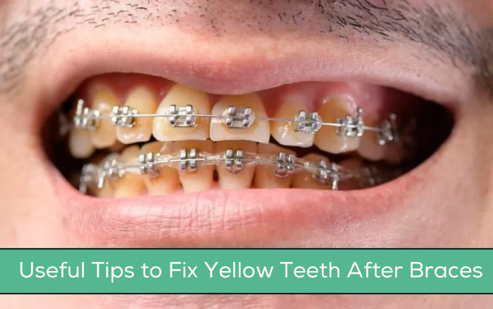 Useful Tips to Fix Yellow Teeth After Braces