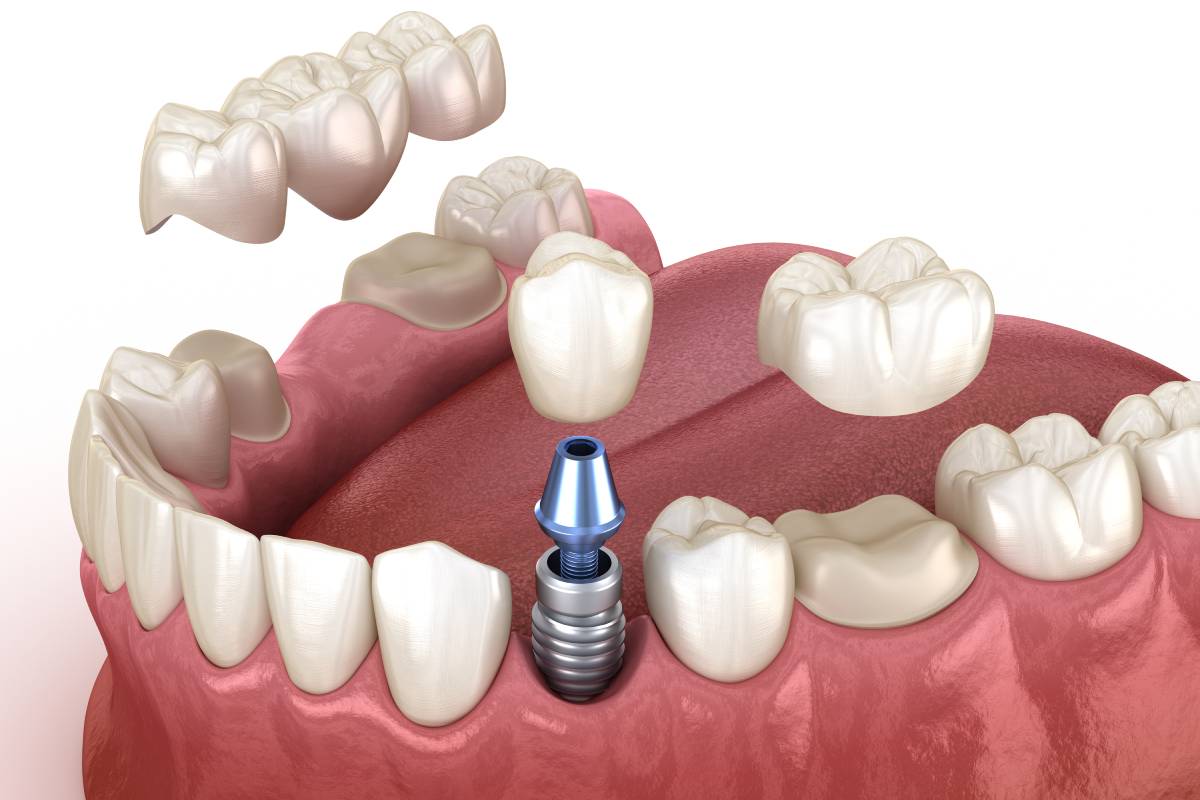 Dental Crowns and Bridges in Kharadi