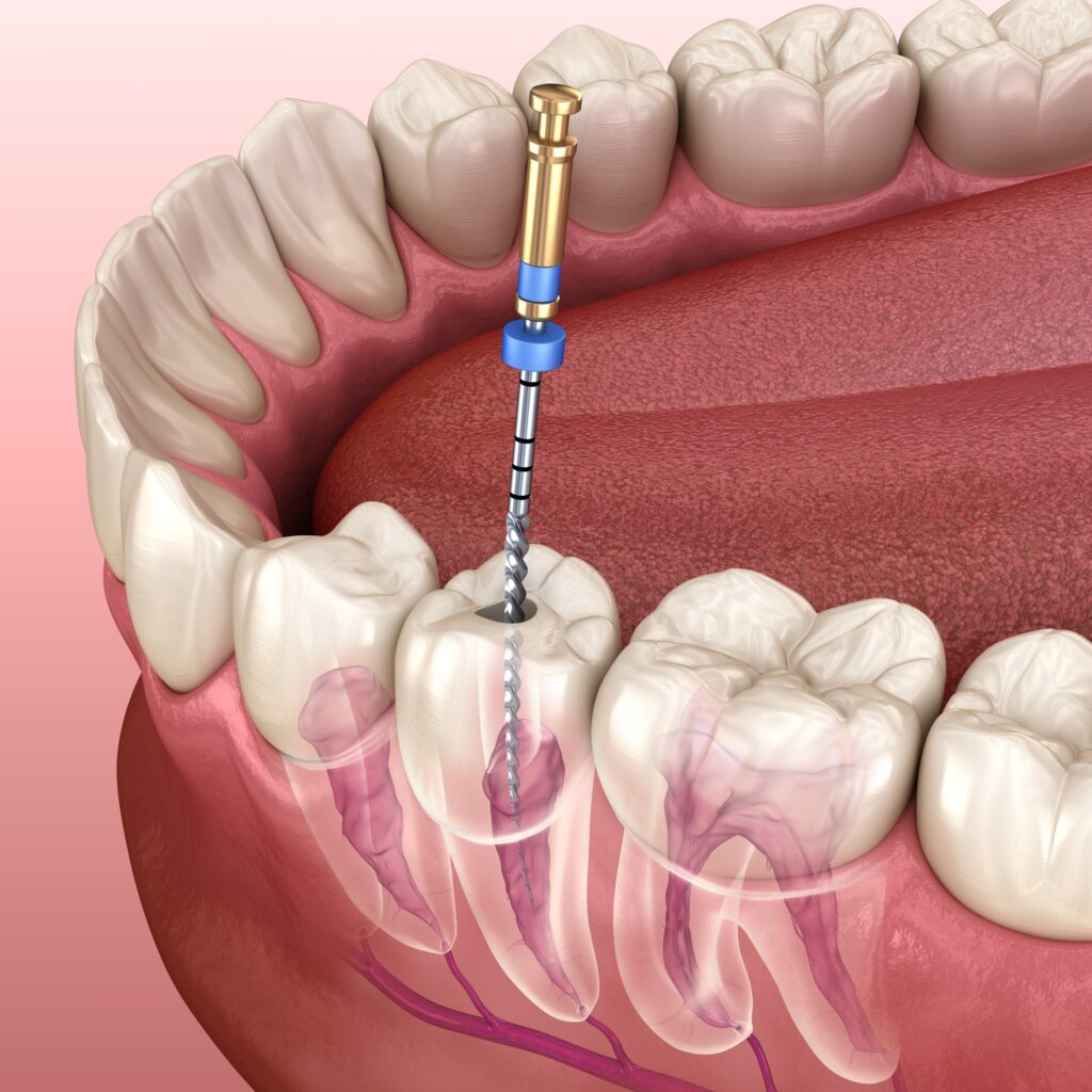 Root Canal Treatment in Kharadi | Root Canal Specialist-Theteamdental