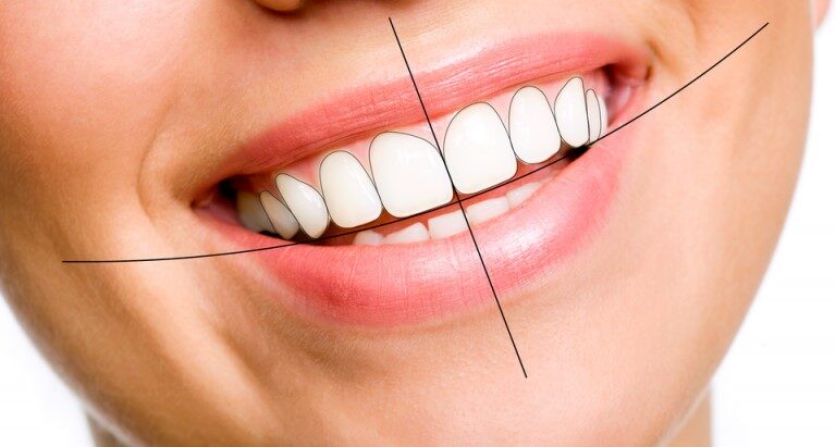 Smile Designing