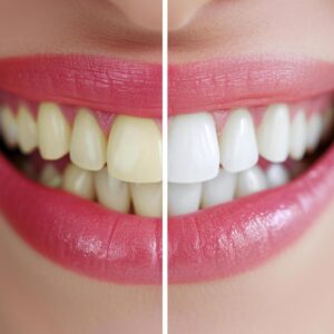 teeth whitening