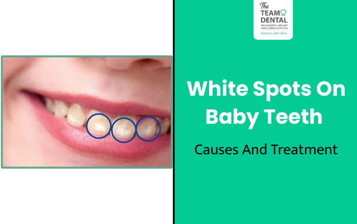 White Spots On Baby Teeth – Causes And Treatment