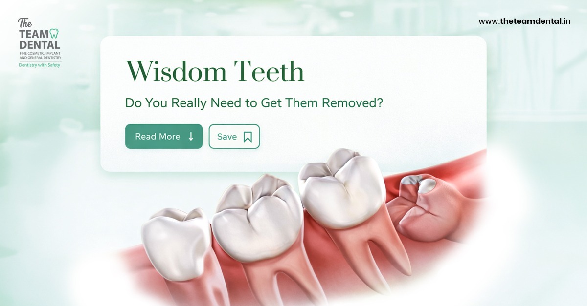 Wisdom Teeth: Do You Really Need to Get Them Removed?