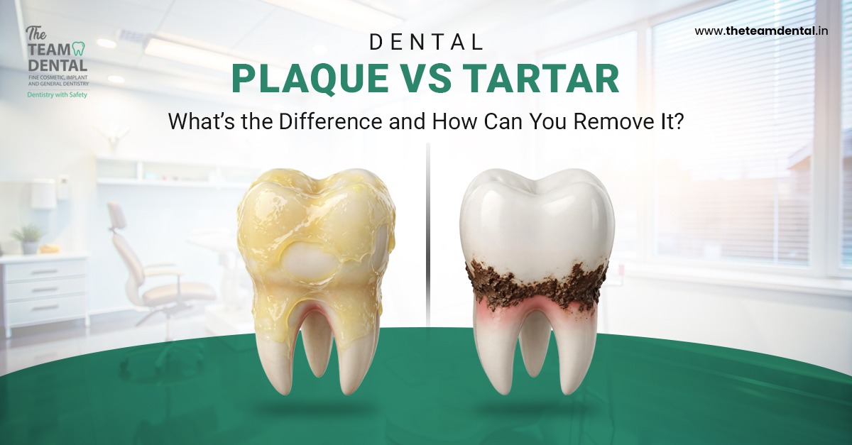 Dental Plaque vs Tartar: What’s the Difference and How Can You Remove It?